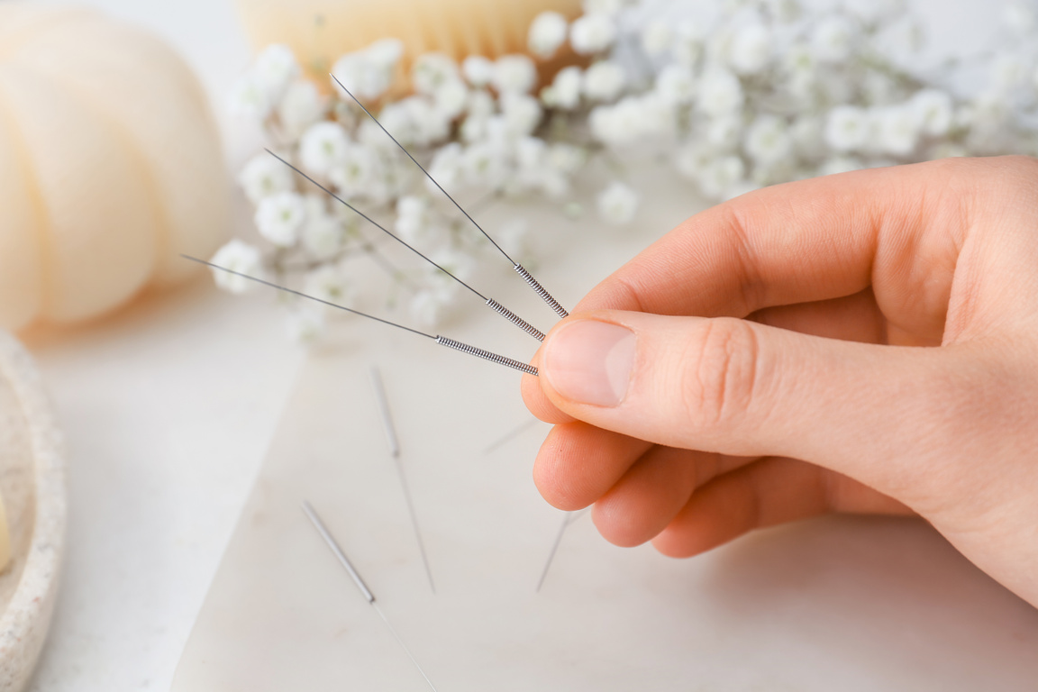 Female Hand with Acupuncture Needles on Table